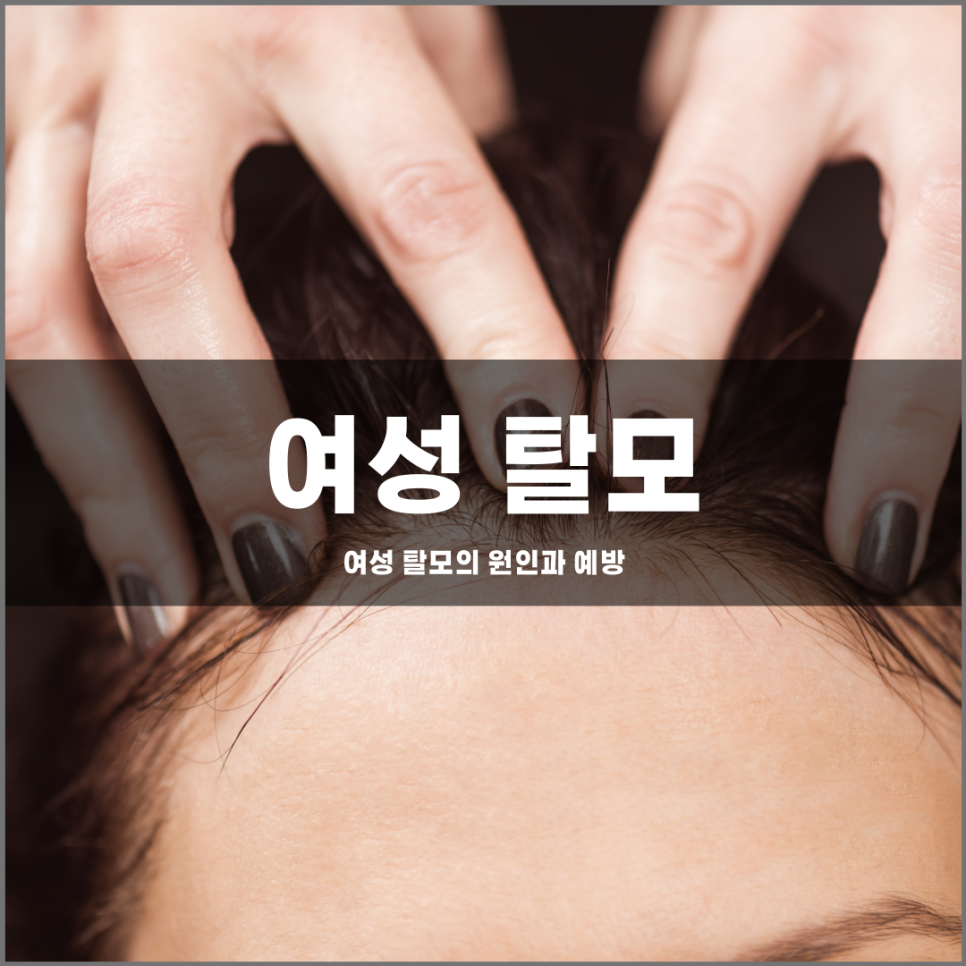여성 탈모의 원인과 예방